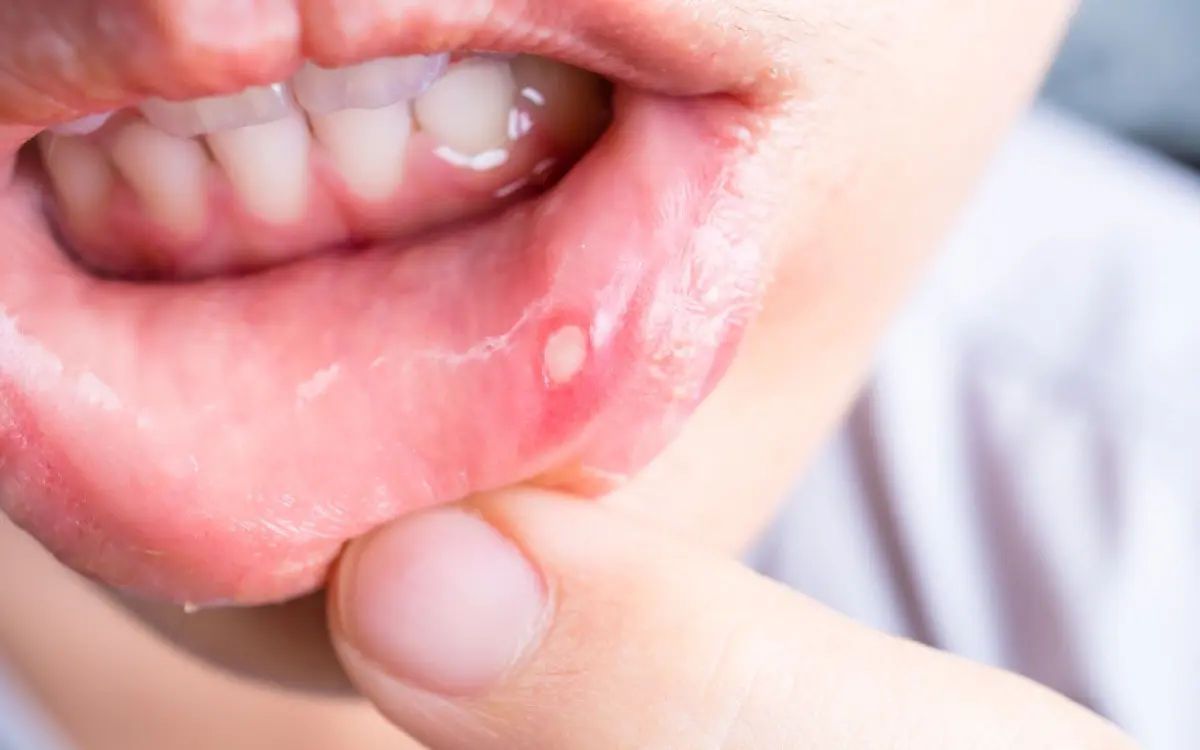 cold sore inside mouth